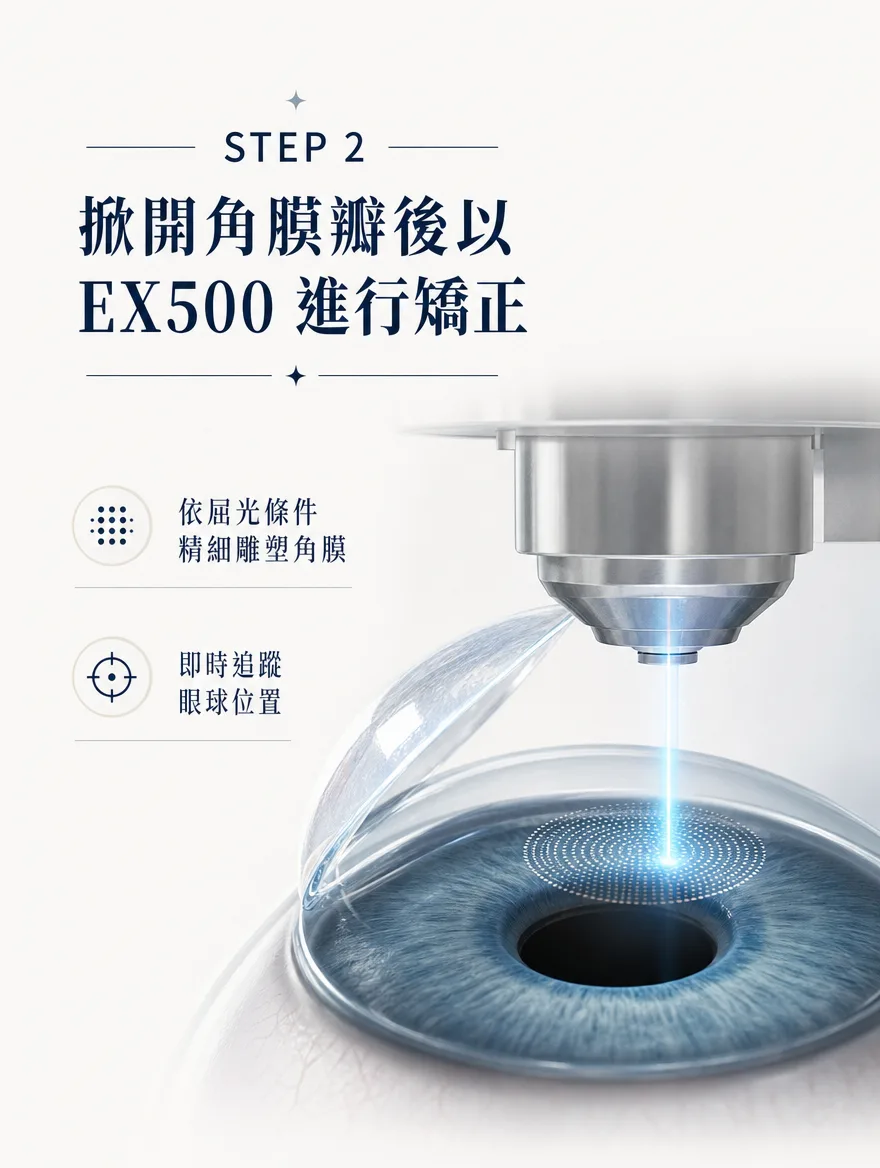 全雷射LASIK — 掀開角膜瓣後以 EX500 進行矯正 — 依屈光條件精細雕塑角膜,並即時追蹤眼球位置。