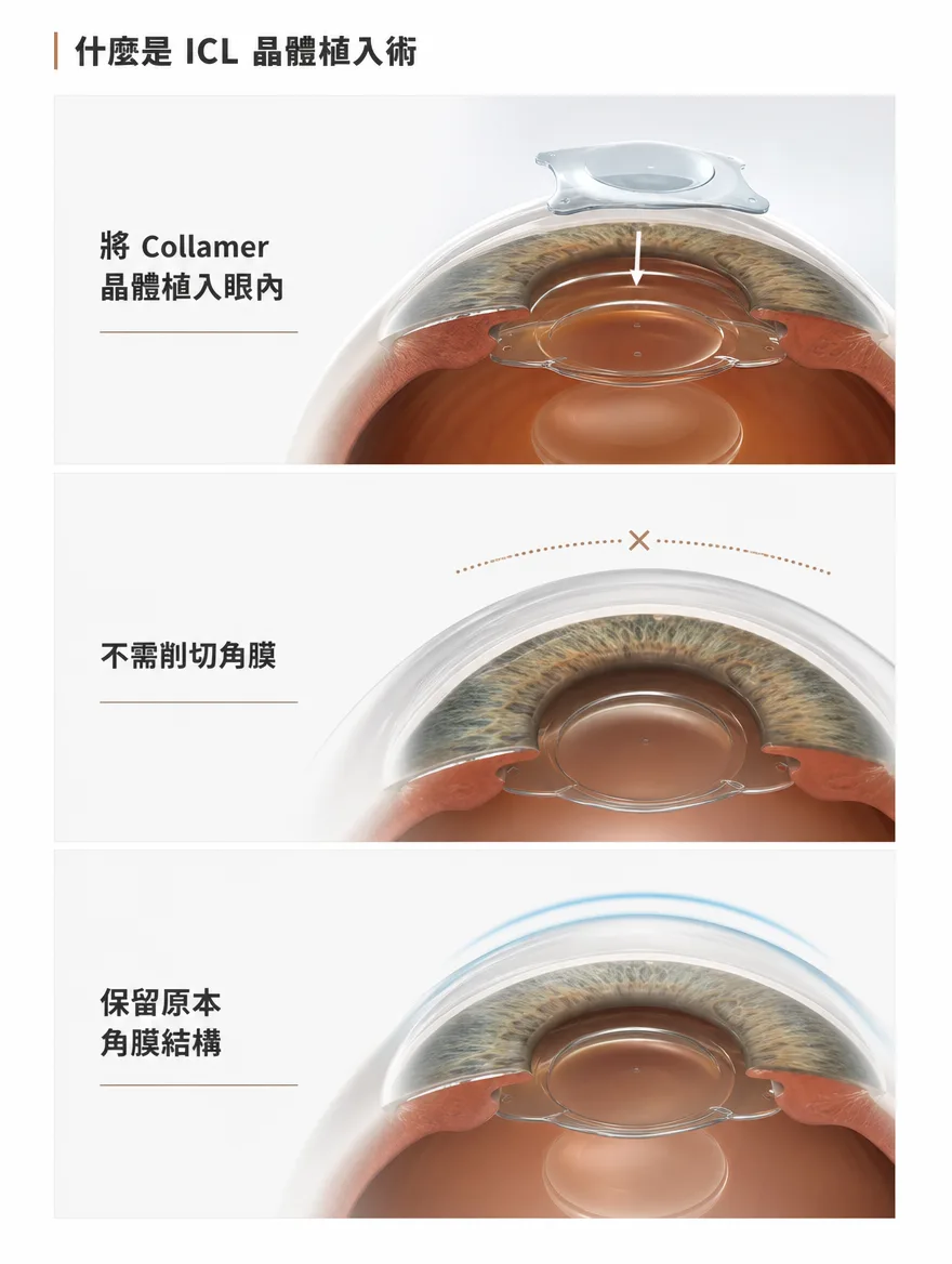 眼內鏡片植入術（ICL） — 什麼是 ICL 晶體植入術 — 將 Collamer 材質的晶體植入眼內，不需削切角膜，保留原本角膜結構。