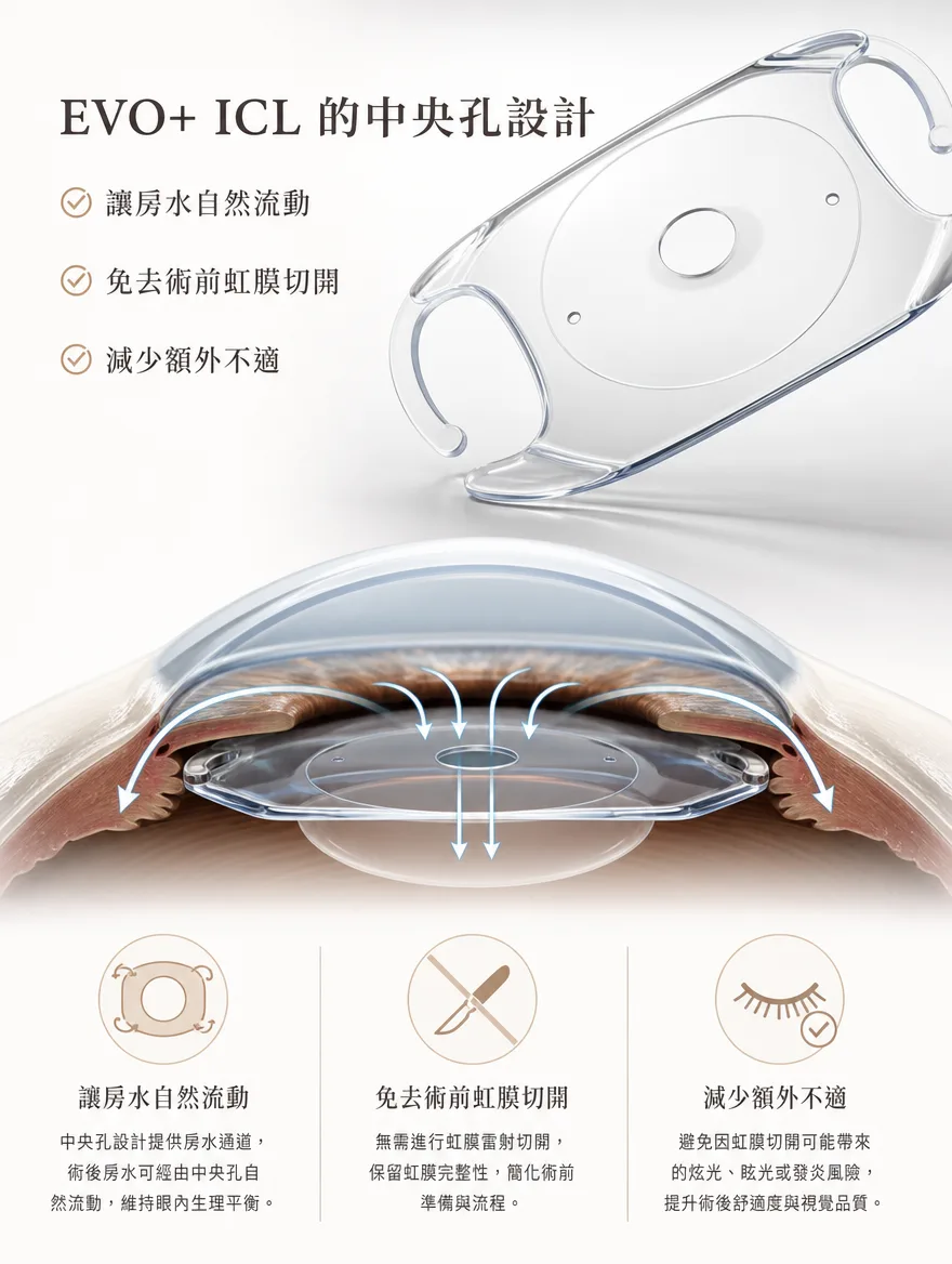 眼內鏡片植入術（ICL） — EVO+ ICL 的中央孔設計 — 中央孔設計提供房水通道，術後房水可經由中央孔自然流動，維持眼內生理平衡；無需進行虹膜雷射切開，保留虹膜完整性；避免因虹膜切開可能帶來的炫光、眩光或發炎風險，提升術後舒適度與視覺品質。