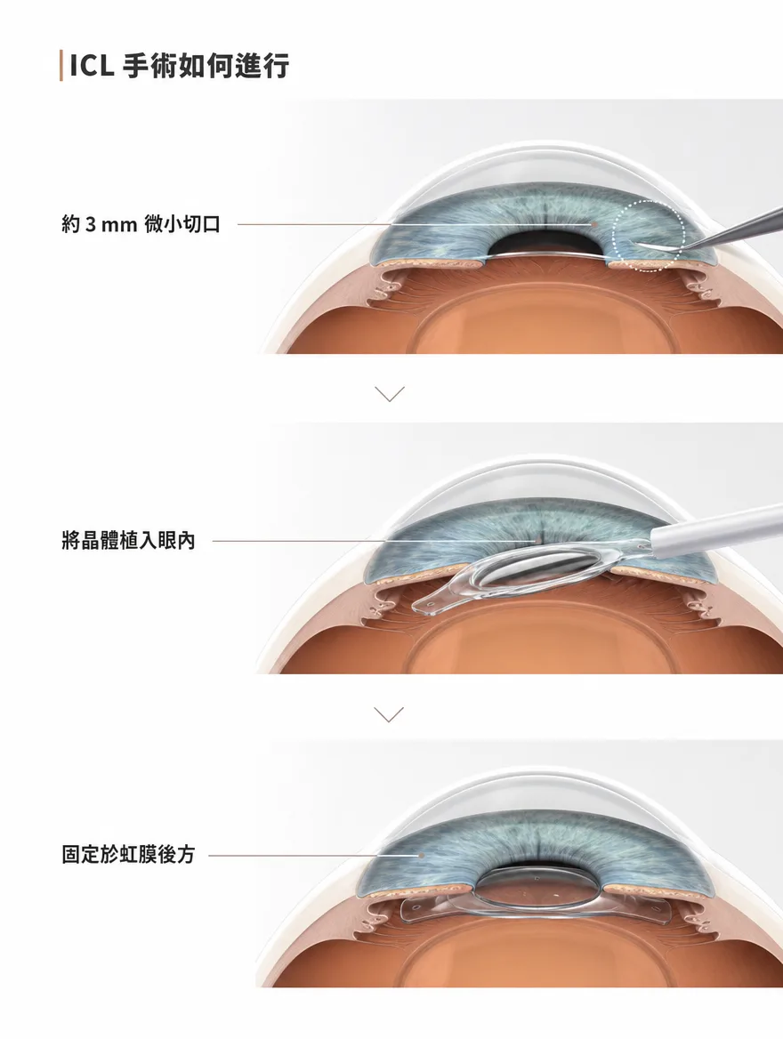 眼內鏡片植入術（ICL） — ICL 手術如何進行 — 透過約 3mm 的微小切口，將晶體植入眼內，並固定於虹膜後方。