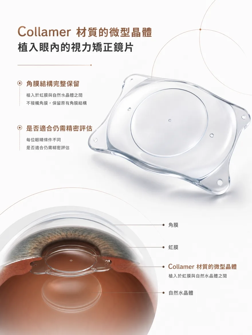 眼內鏡片植入術（ICL） — Collamer 材質的微型晶體 — 植入於虹膜與自然水晶體之間，不接觸角膜，保留原有角膜結構。每位眼睛條件不同，是否適合仍需精密評估。