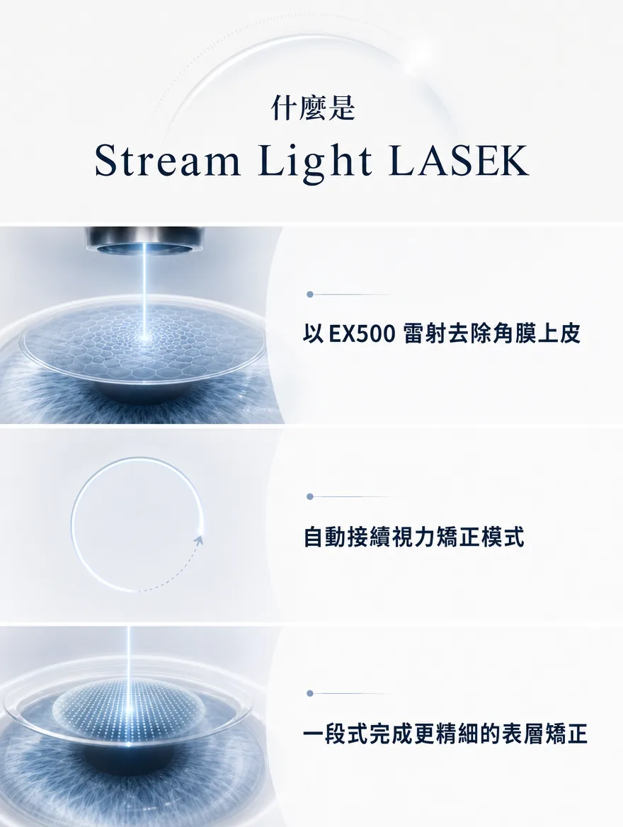 StreamLight 經上皮雷射(LASEK) — Stream Light LASEK — 以EX500雷射去除角膜上皮,自動接續進入視力矯正模式,一段式完成更精細的表層矯正。