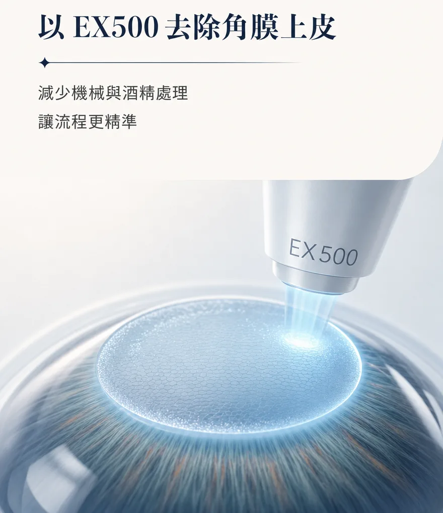 StreamLight 經上皮雷射(LASEK) — 以 EX500 去除角膜上皮 — 減少機械與酒精處理,讓流程更精準。